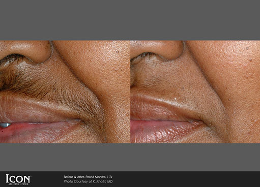 Hair Removal before and after