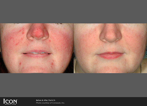 Skin Rejuvenation before and after