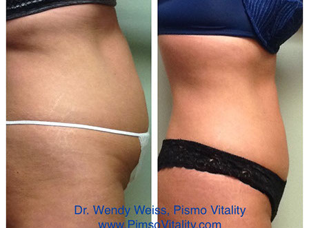 Smartlipo before and after, Dr. Wendy Weiss, Pismo Vitality