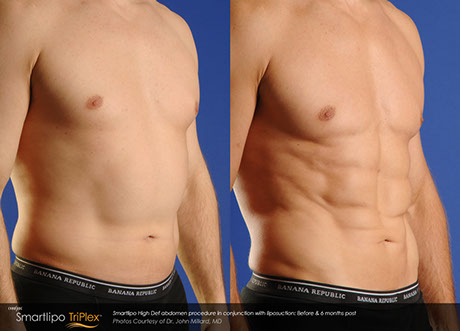 Body Contouring before and after