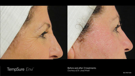 TempSure before and after